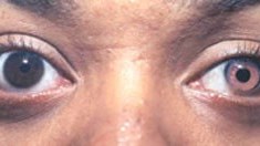 After Iris Reconstructive Lens